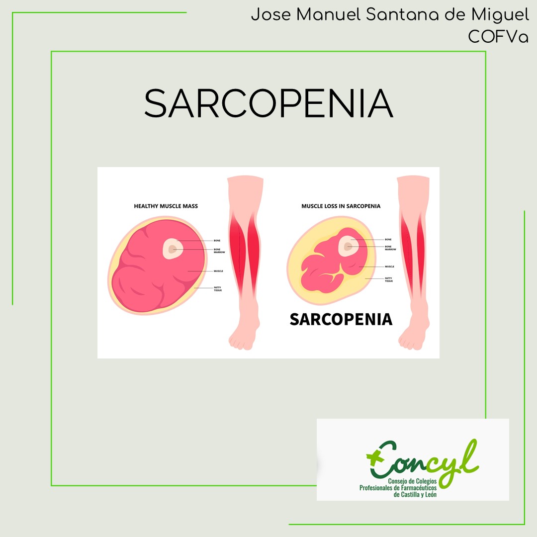 Sarcopenia Diapositiva 1